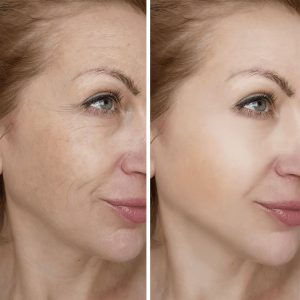 پوستی شاداب بعد از خدمات پوستی سالن در مراقبت تخصصی از پوست در فصل پاییز کرج