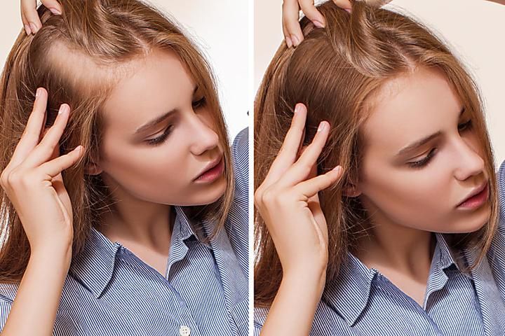 اوزون تراپی مو در تفاوت بین روش های مختلف احیای مو در بهترین سالن زیبایی کرج