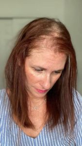 استرس برای مراقبت از موهای کم پشت در کرج